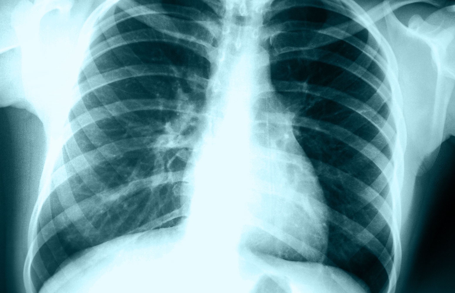 Chest X-ray Essentials