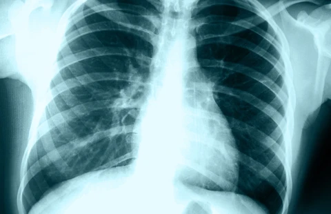 Chest X-ray Essentials