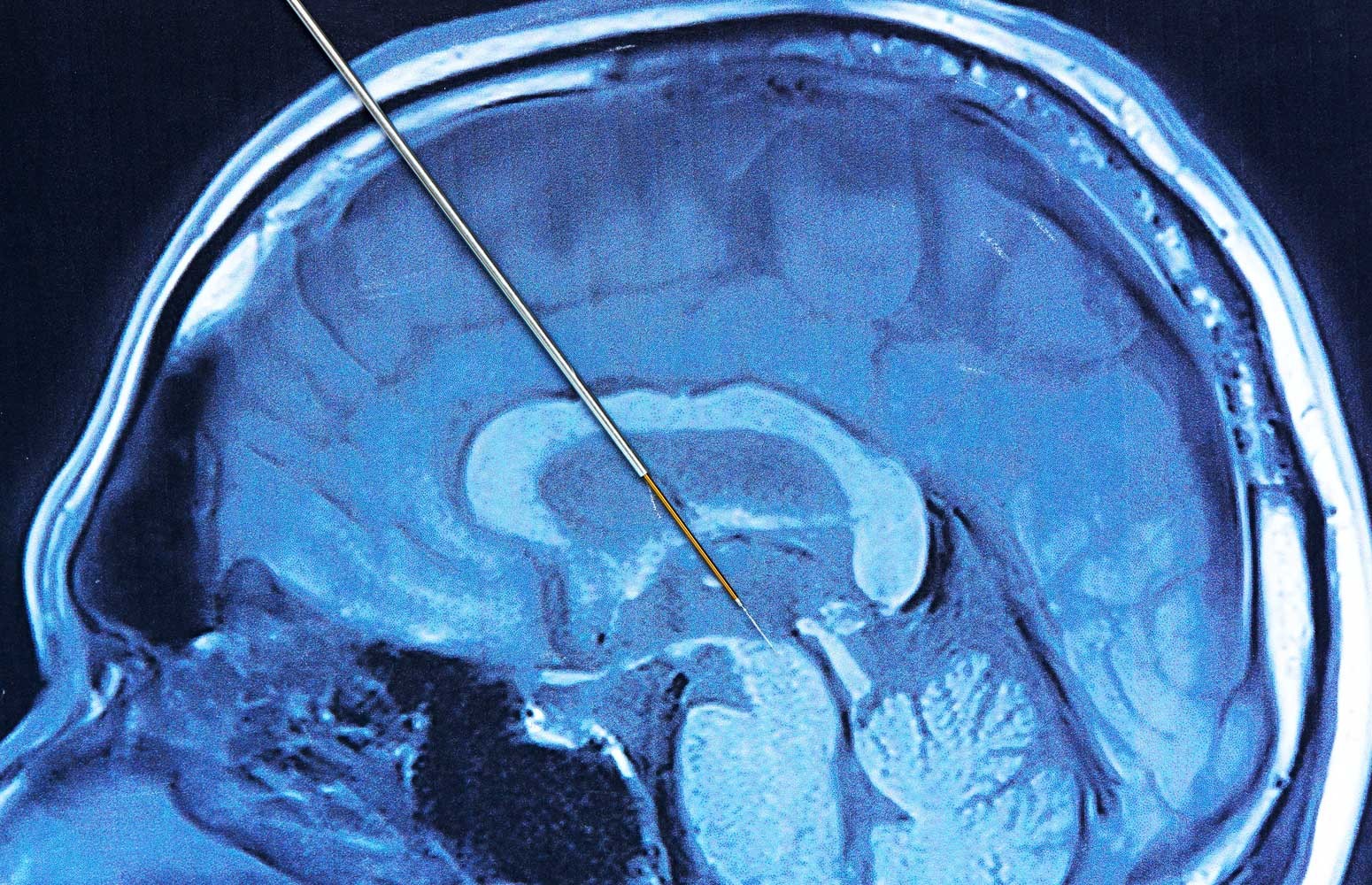 Parkinson's Masterclass: Advanced Therapeutics