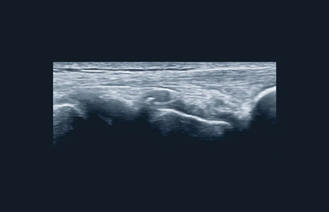 Curso avanzado de ecografía musculoesquelética