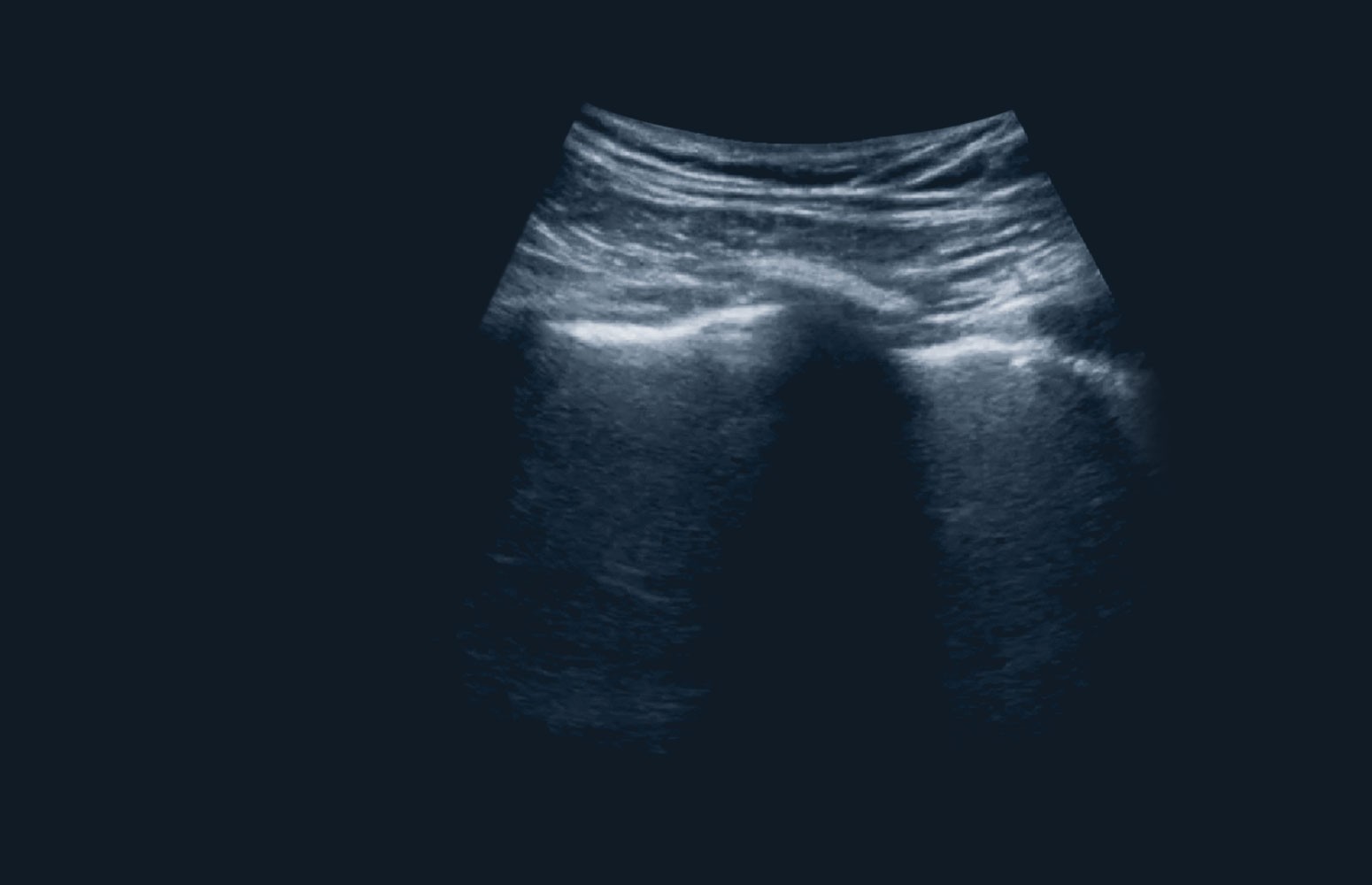 COVID Mini: Lung Ultrasound