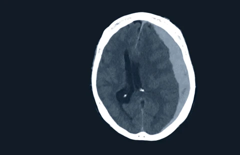 Brain CT Essentials