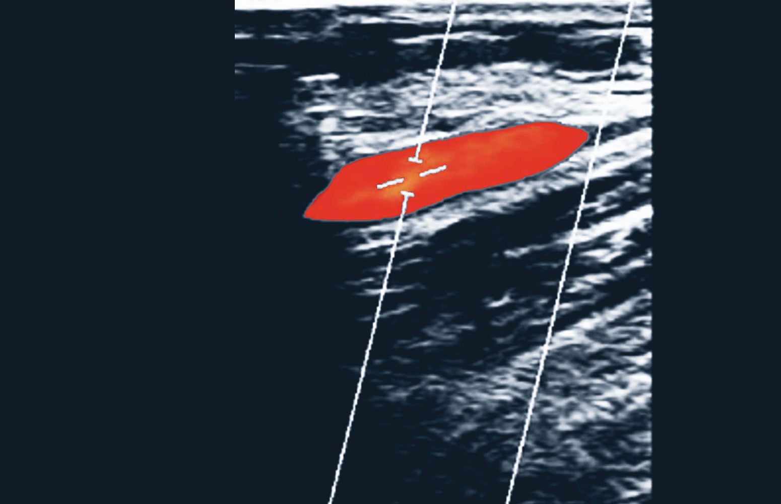 Ultrasound Masterclass: Dialysis Fistulas