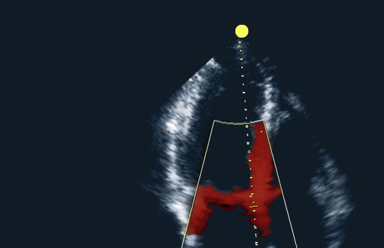 Echo Masterclass: Left Ventricular Strain