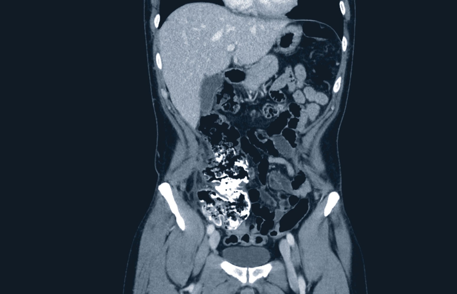 Abdominal CT Masterclass: Common Pathologies