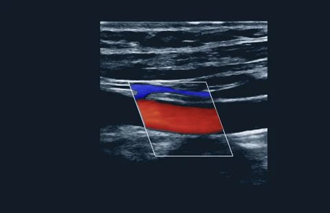 Ultrasound Masterclass: The Carotid Artery