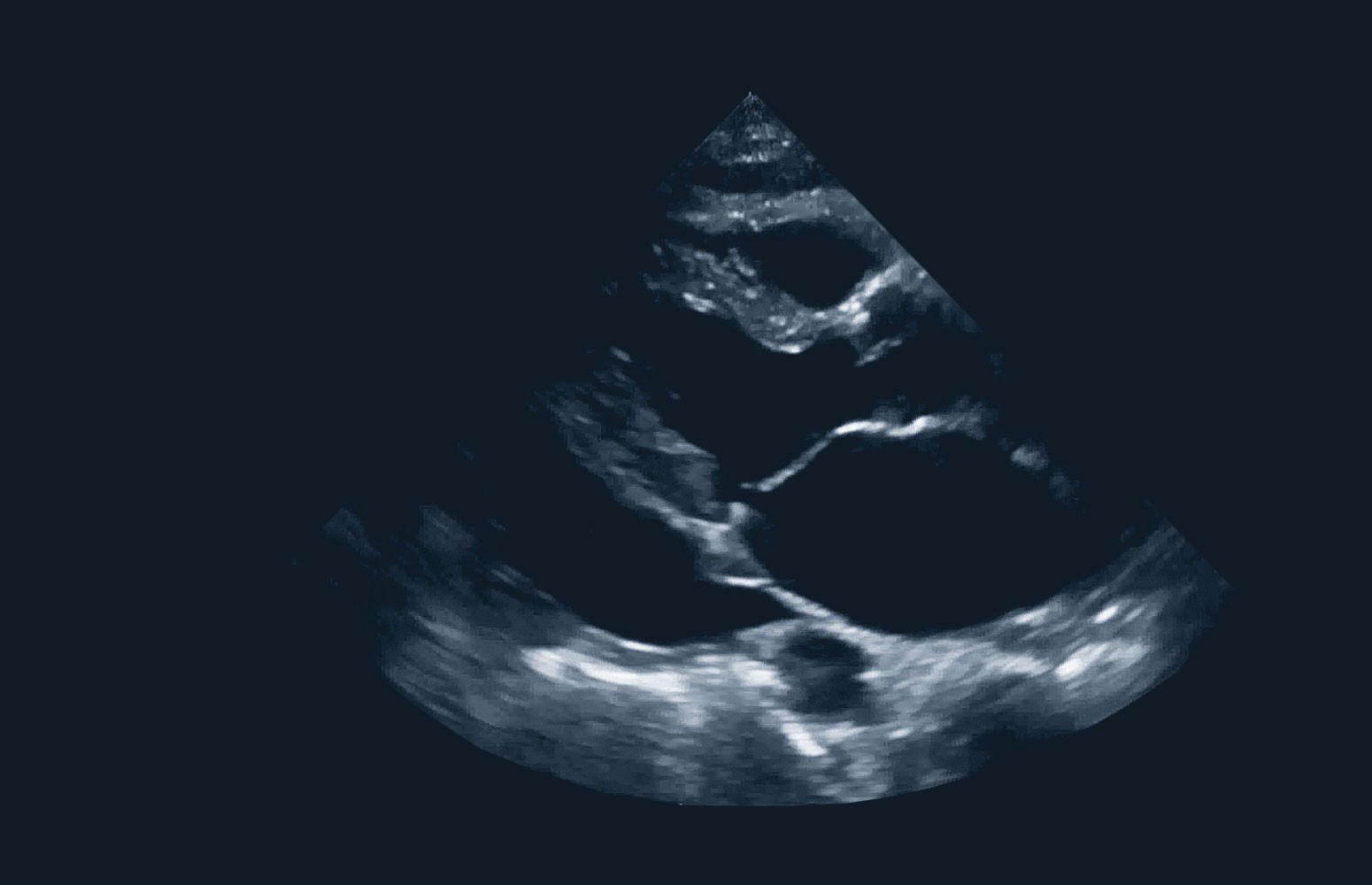 Cardiac Tamponade