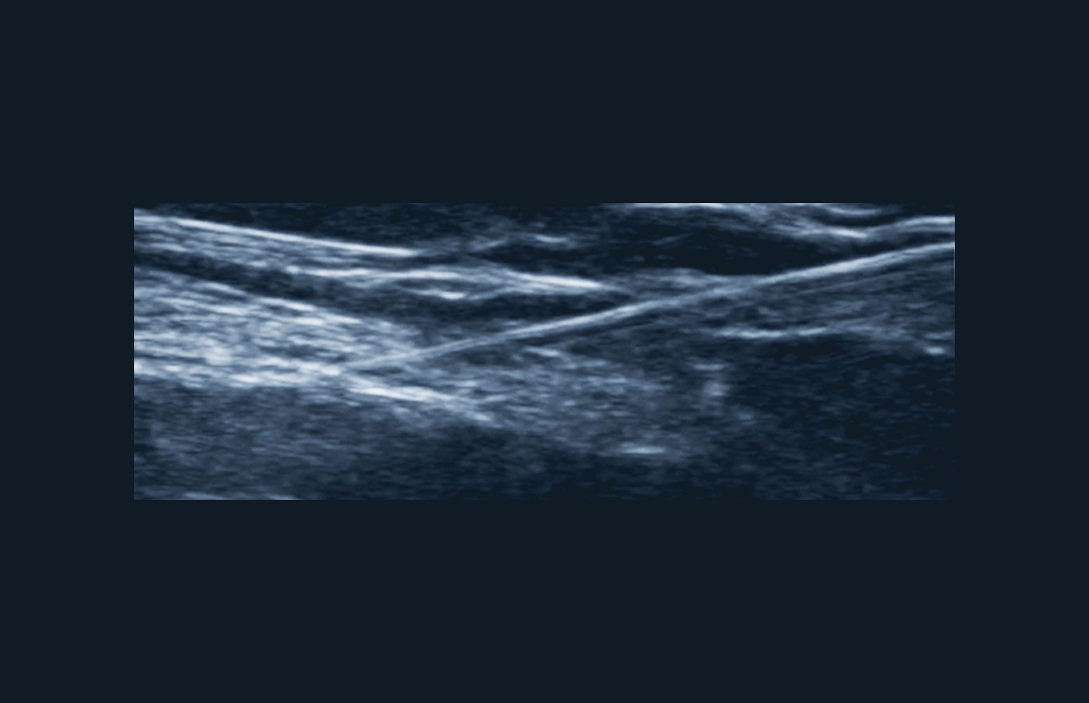 Ultrasound-Guided Nerve Block Masterclass