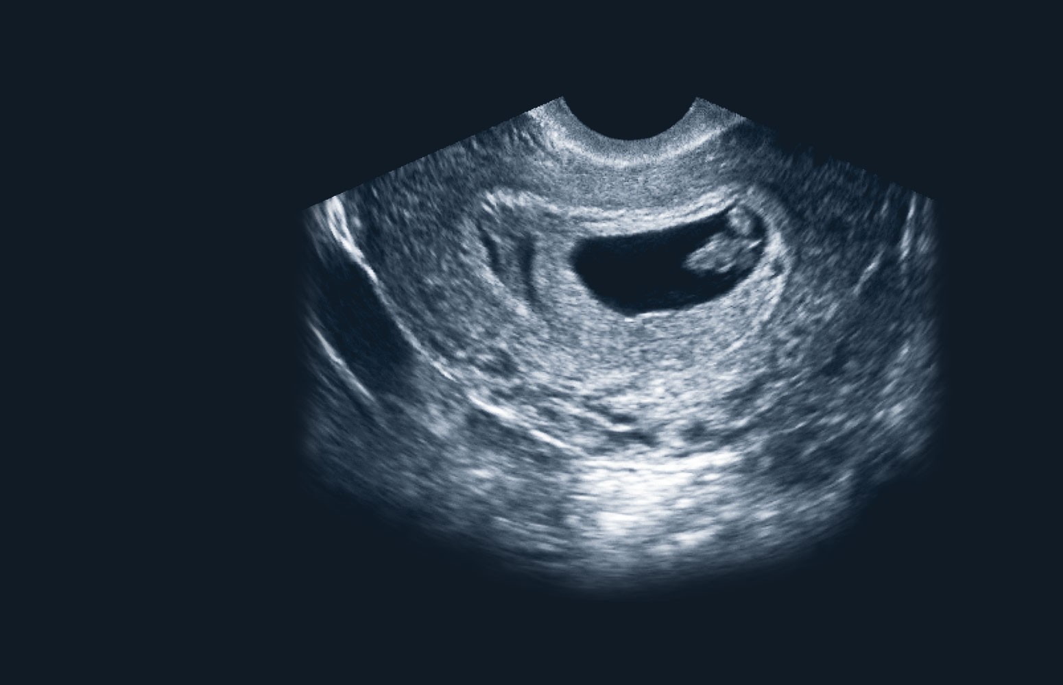 First Trimester Ultrasound Power Hour