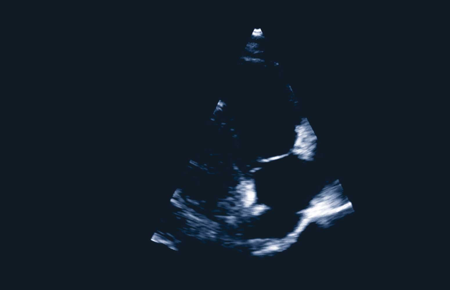 Echo Masterclass: The Right Heart