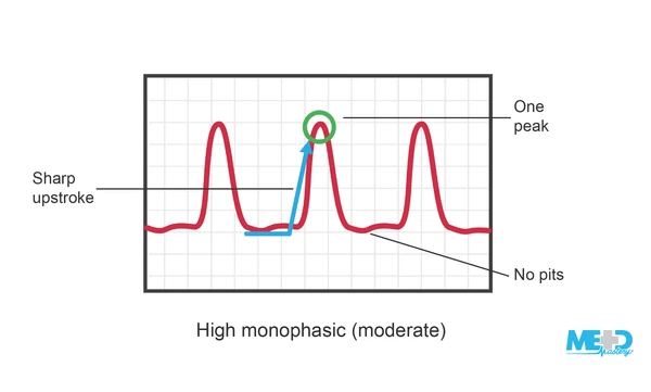 How to interpret ankle-brachial index (ABI) waveforms ...