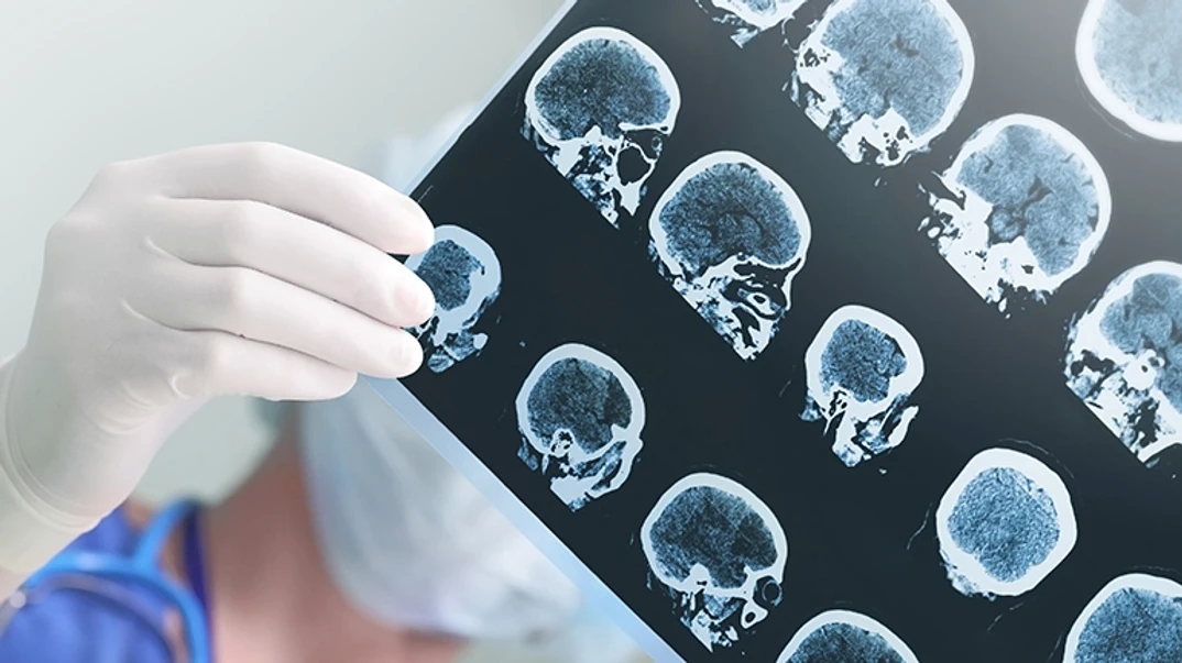 Brain CT