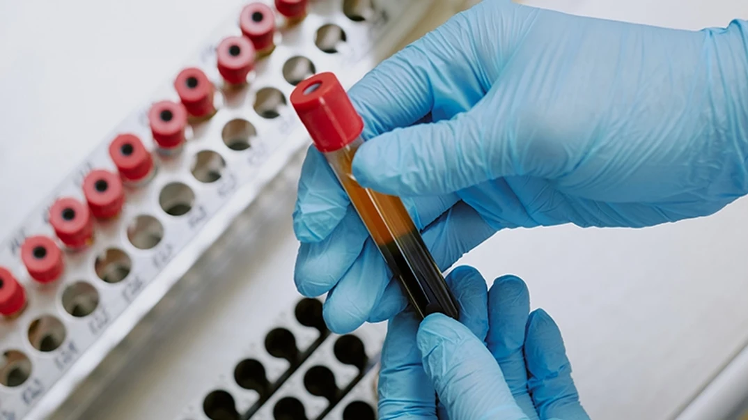 Liver labs