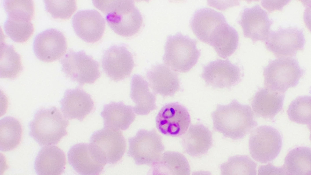 Malaria