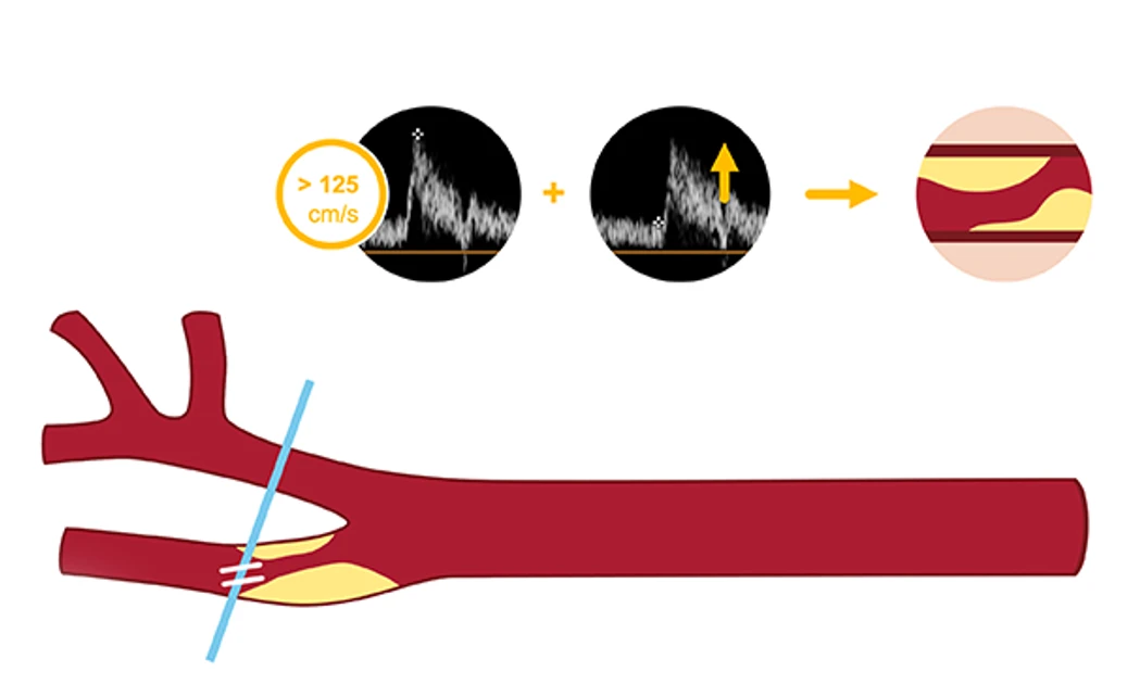 Identifying carotid artery disease with ultrasound | Medmastery