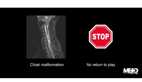 健康・医学 Spinal control Therapeutic Exercise for Lumbopelvic Stabilization: A Motor