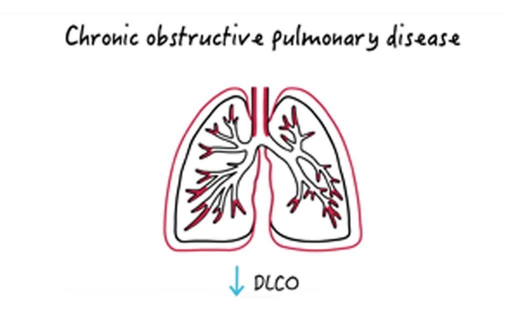 Diffusing Capacity Normal Chart What is diffusing capacity and why is it important? | Medmastery